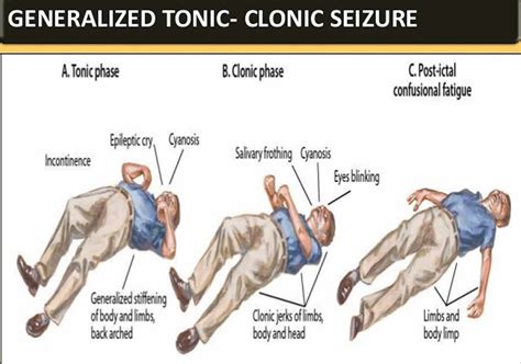 bad tonic clonic seizure